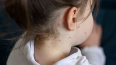 Kızamık vakalarında artış! Bakan Koca’dan dikkat çeken açıklama…