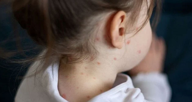 Kızamık vakalarında artış! Bakan Koca’dan dikkat çeken açıklama…