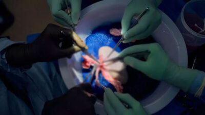 Ölen kişiye domuz böbreği nakli yapıldı! Günlerce çalışmayı başardı