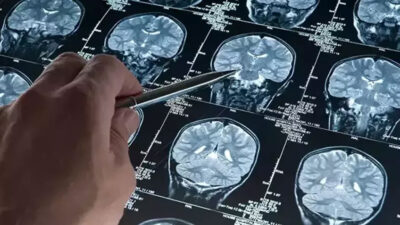 Bilim insanları Alzheimer hastalarında beyin hücrelerinin neden öldüğünü keşfetti