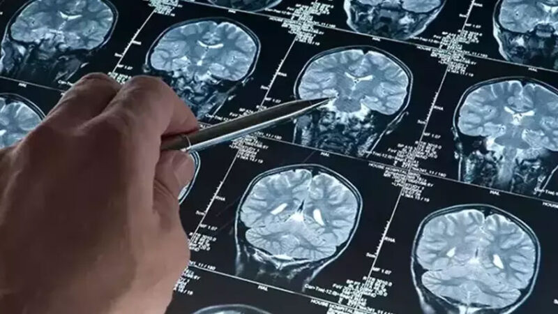 Bilim insanları Alzheimer hastalarında beyin hücrelerinin neden öldüğünü keşfetti İngiltere ve Belçika'da bilim insanları tarafından yapılan yeni bir araştırma,