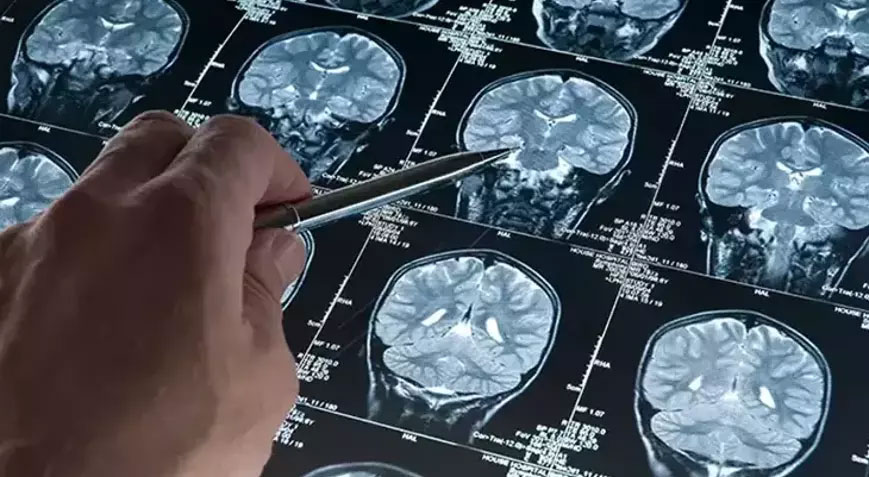 Bilim insanları Alzheimer hastalarında beyin hücrelerinin neden öldüğünü keşfetti