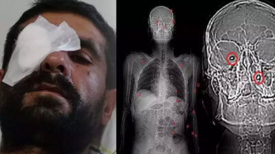 4 kişi pusu kurdu kurşun yağdırdı! 20 gündür saçmalarla yaşıyorum