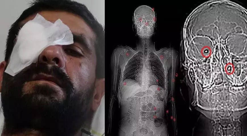 4 kişi pusu kurdu kurşun yağdırdı! 20 gündür saçmalarla yaşıyorum