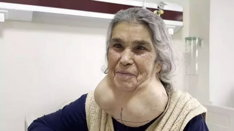 50 yıl boyunca hastaneye gitmedi, 2 kiloluk kitleyle 50 yıl yaşadı Denizli'de boynun ön alt kısmında büyük bir şişliğin oluşmasına rağmen