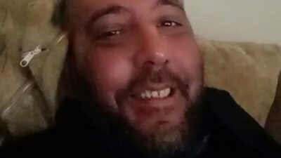 Covid-19’dan sonra milyonda 2 görülen hastalığa yakalandı: Yüzü tanınmaz hale geldi