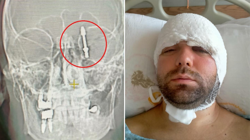 Bursa’da inanılmaz olay! İmplant tedavisinde vida beynine saplandı