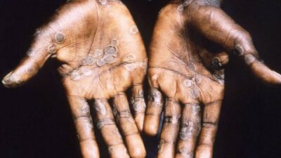 Bursa’da flaş ‘Maymun Çiçeği’ açıklaması! Yeni pandemi yolda mı?