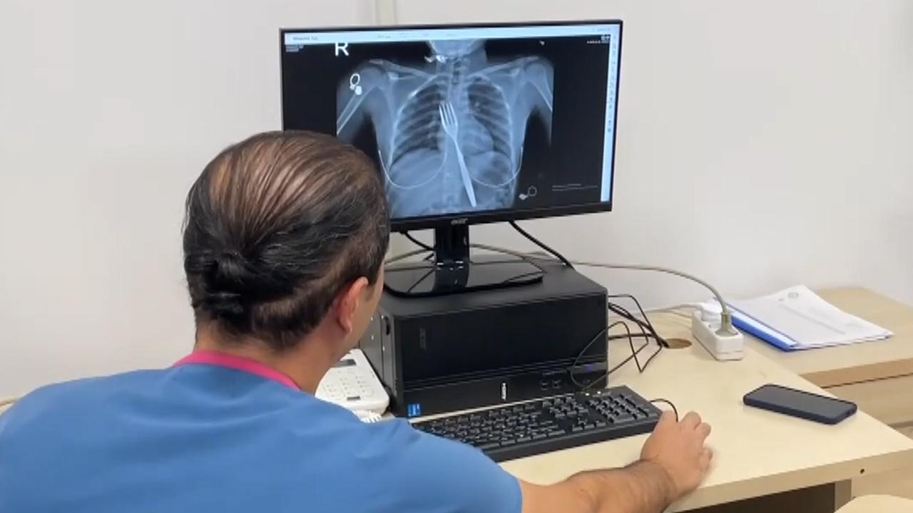 18 santimlik çatal yuttu! Bilimsel makaleye konu olacak