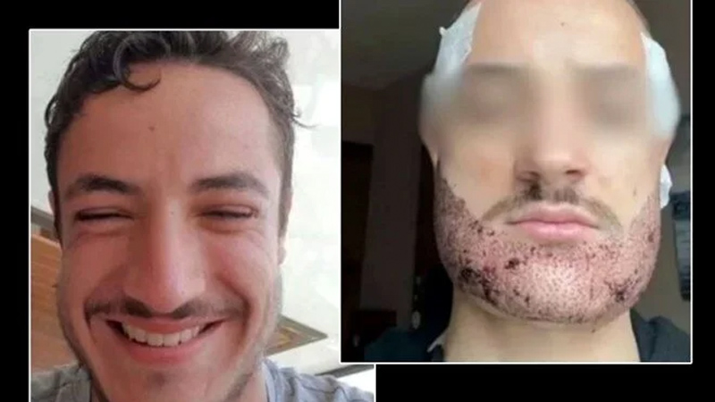 Sakal ekimi sonrası intihar iddiası: ‘Doktor değil emlakçı!’ Sakal ekimi sonrası intihar iddiası: ‘Doktor değil emlakçı!’