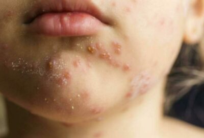 ABD’de salgın alarmı! 12 eyalete yayıldı