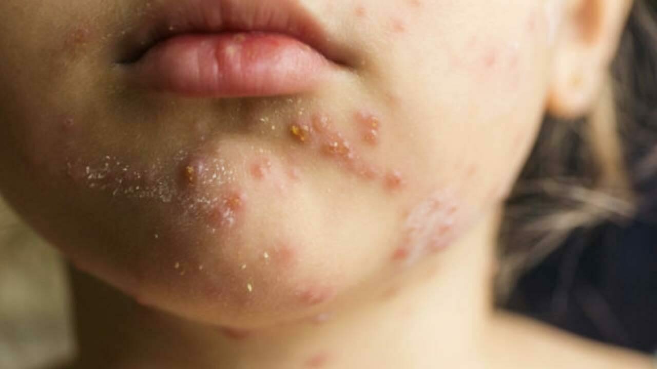 ABD’de salgın alarmı! 12 eyalete yayıldı