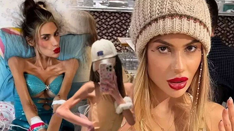 Anoreksiya yaygınlaşıyor: 15 yaşa kadar indi Anoreksiya yaygınlaşıyor: 15 yaşa kadar indi