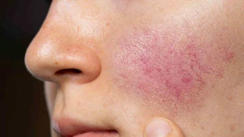 Uzman isim uyardı: İhmal etmeyin Hayat Hastanesi Dermatoloji Uzmanı Dr. Mediha Yılmaz, halk arasında ’gül