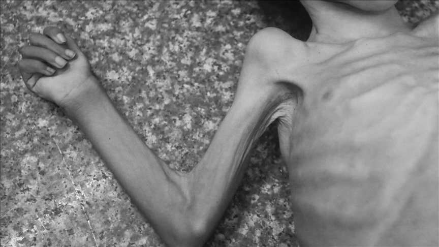 Gazze’de insanlık dramı! Açlıktan ölenlerin sayısı 339’a çıktı