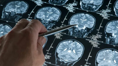 Yeni bir nörolojik hastalık keşfedildi: Yalnızca 13 kişide görüldü