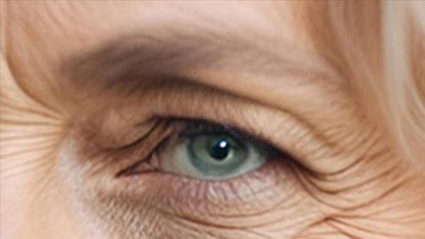 BURTOM’dan göz kapağı sarkmalarına cerrahi çözüm