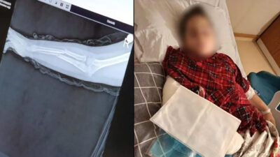 Okulda akran zorbalığı! Arkadaşının kolunu kırdı