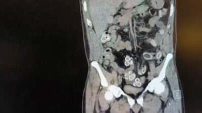 Mide değil esrar deposu! Tutuklandı…