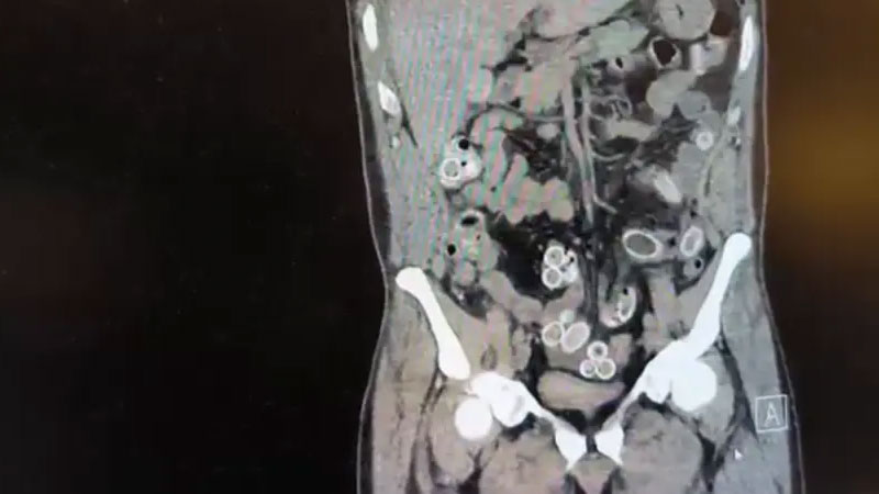 Mide değil esrar deposu! Tutuklandı…