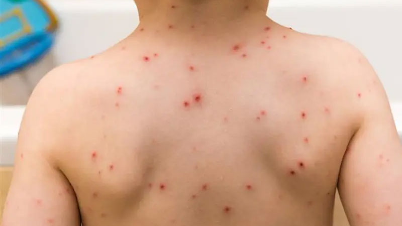 Veliler dikkat! Okullarda vakalar artıyor, hızla yayılıyor! Veliler dikkat! Okullarda vakalar artıyor, hızla yayılıyor!