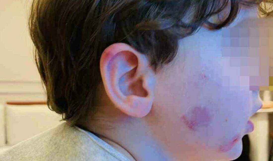 Bursa’daki kreşte skandal iddia! 2,5 yaşındaki çocuk bu hale nasıl geldi? Bursa’nın Gemlik ilçesinde bir anne, sabah saatlerinde sağlıklı şekilde kreşe