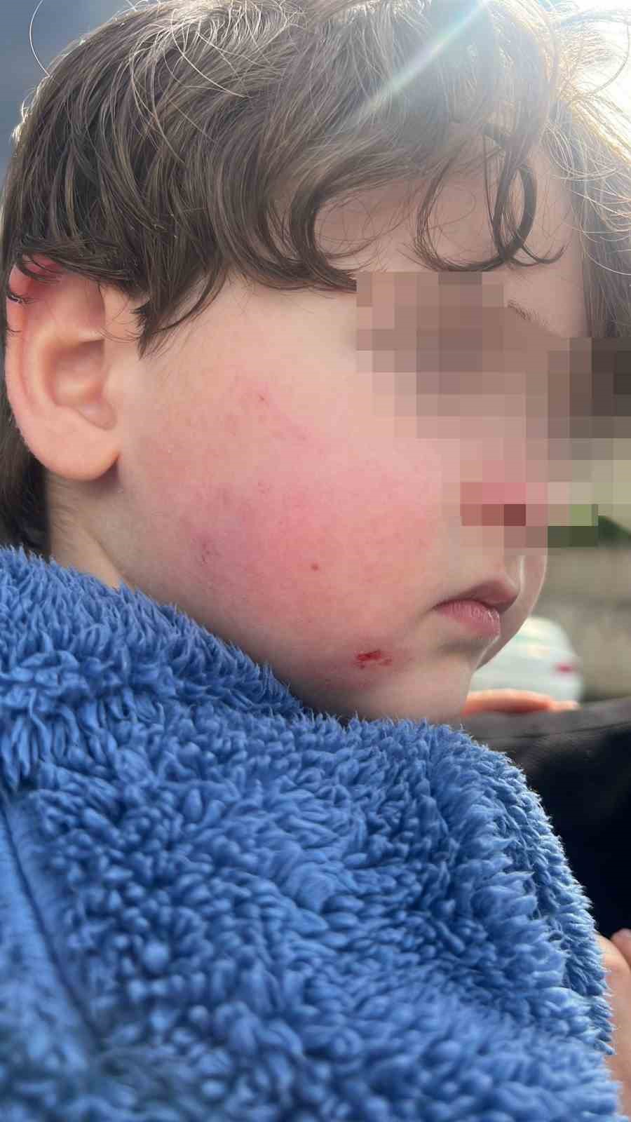 Bursa'daki kreşte skandal iddia! 2,5 yaşındaki çocuk bu hale nasıl geldi? 5 krese biraktigi cocugunu darp edilmis halde aldi e3de2ab588ea