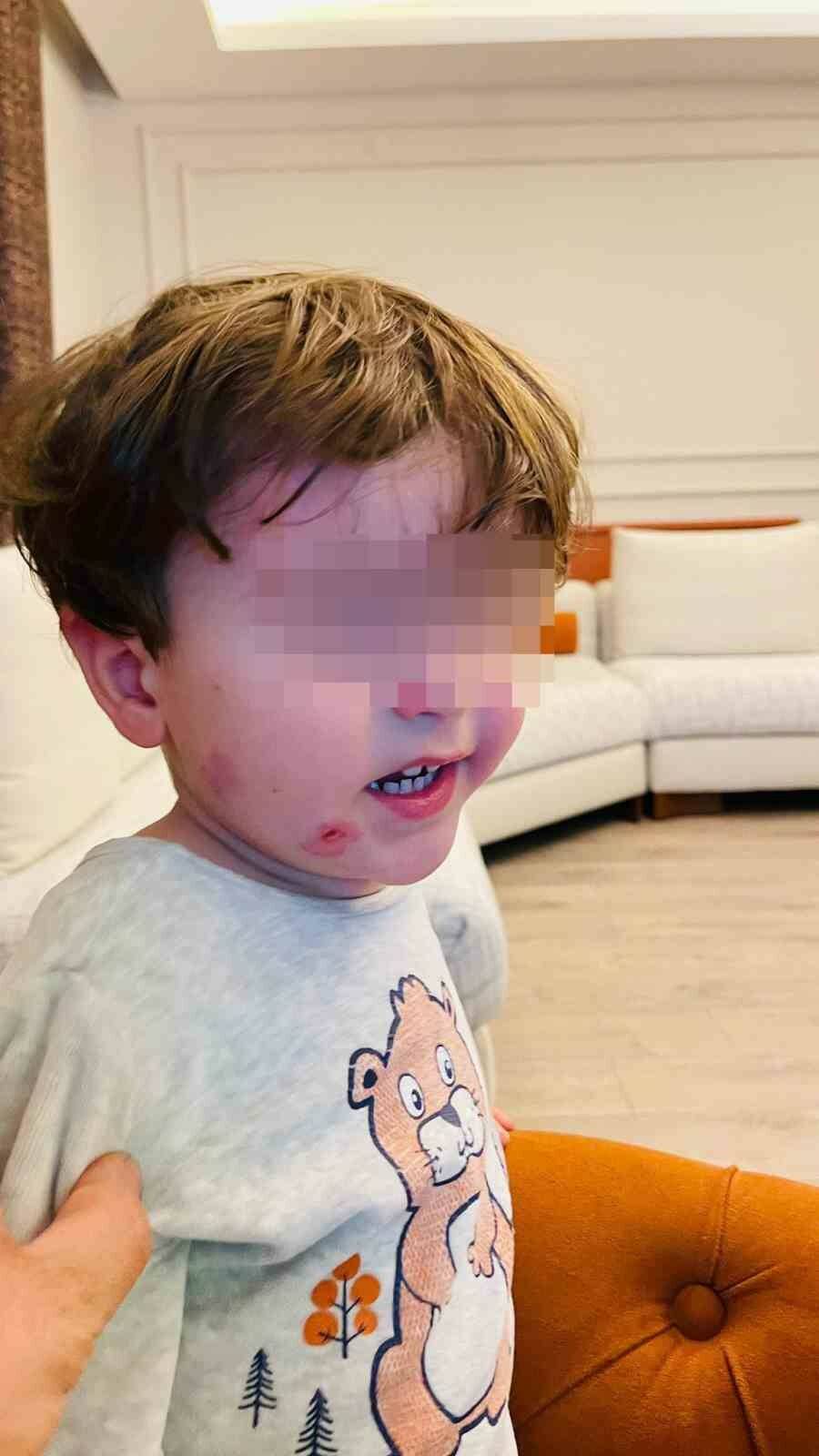 Bursa'daki kreşte skandal iddia! 2,5 yaşındaki çocuk bu hale nasıl geldi? 2 krese biraktigi cocugunu darp edilmis halde aldi f4911cc99bdd